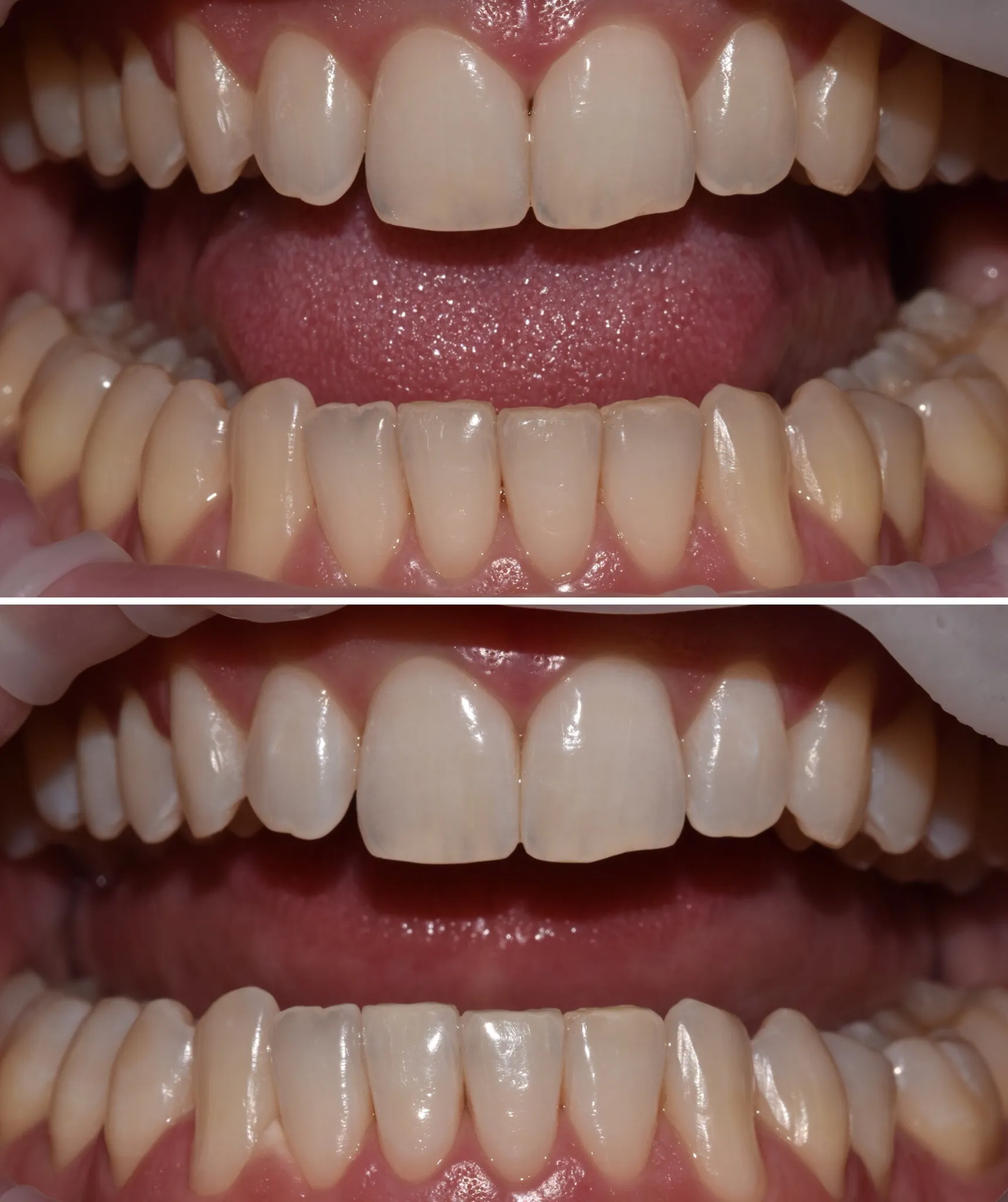 Denti prima (sopra) e dopo (sotto) lo sbiancamento professionale