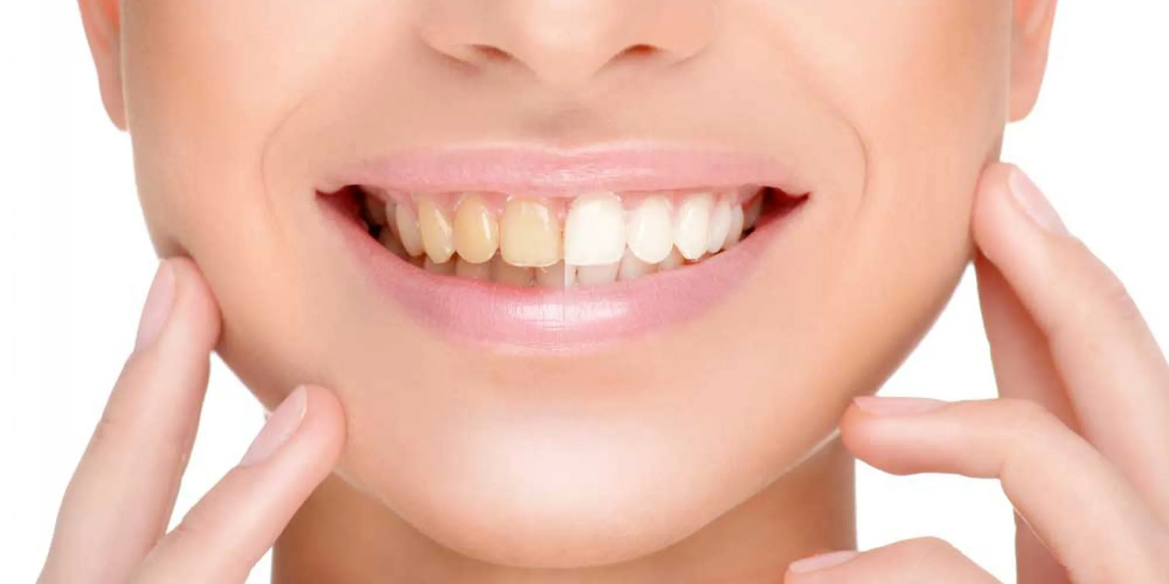 Sorriso dopo lo sbiancamento dentale professionale
