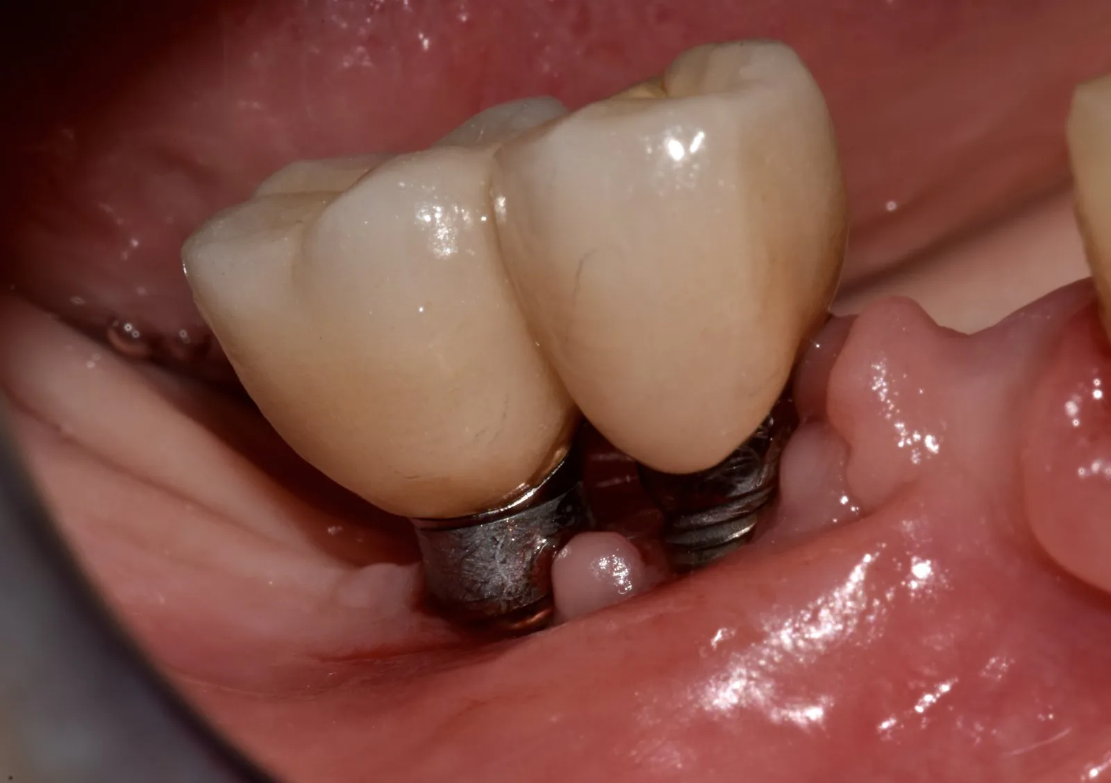 Perimplantite - Igiene Orale Milano